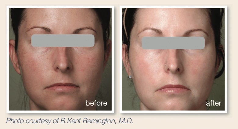 skin rejuventation b a 3